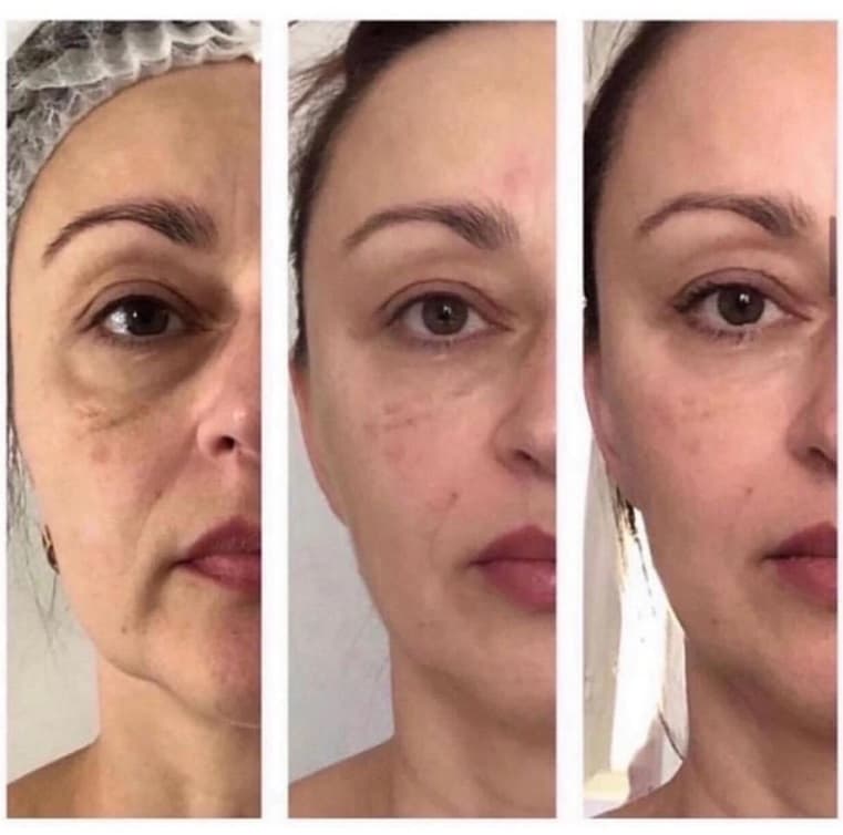 Structural Reset treatment result