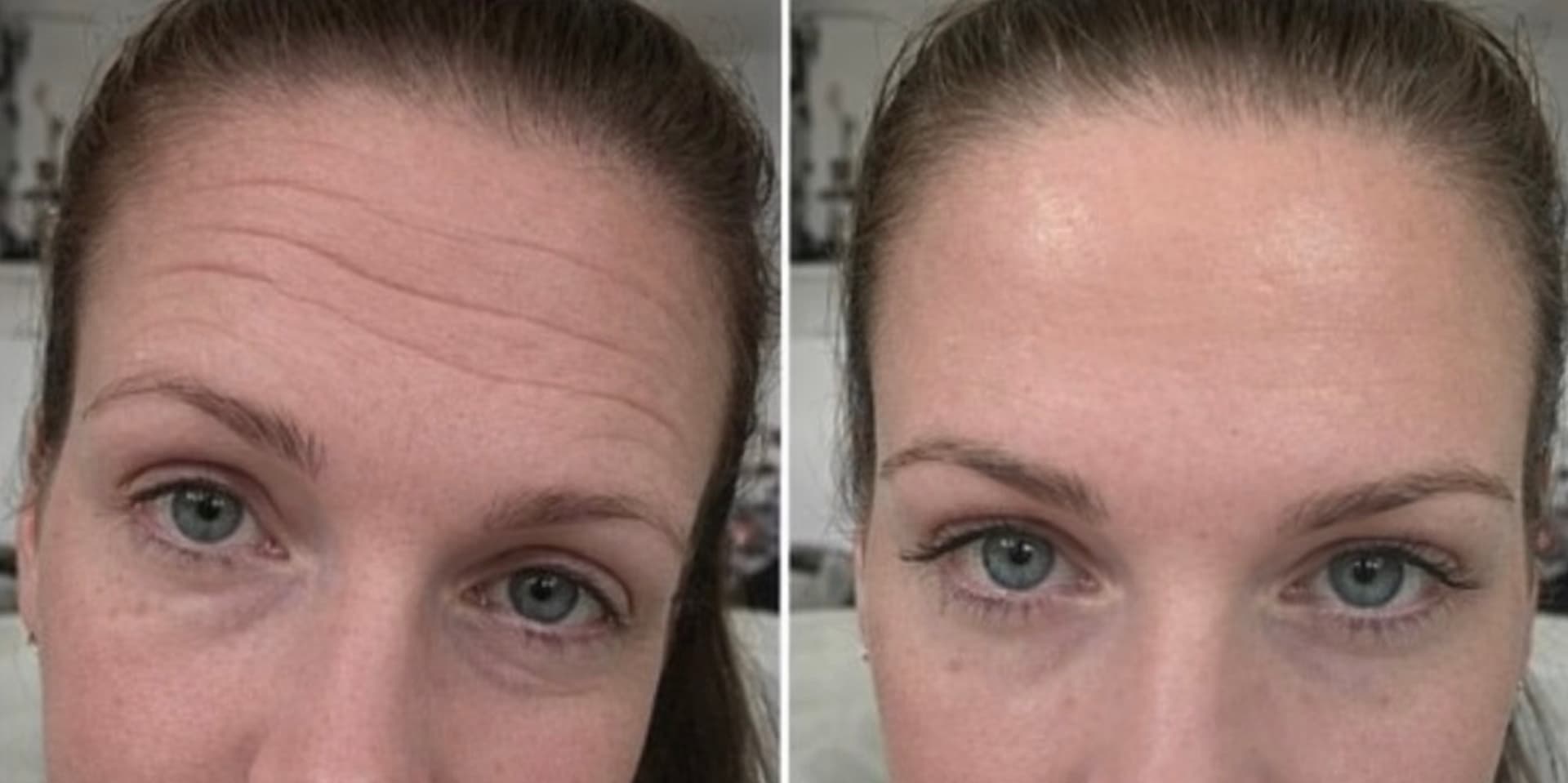 Wrinkle Refinement treatment result